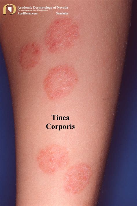 It causes light patches on the. . Tinea corporis images